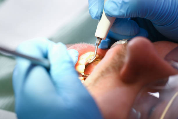 Best Emergency Dental Care for Sports Injuries in Chamblee, GA